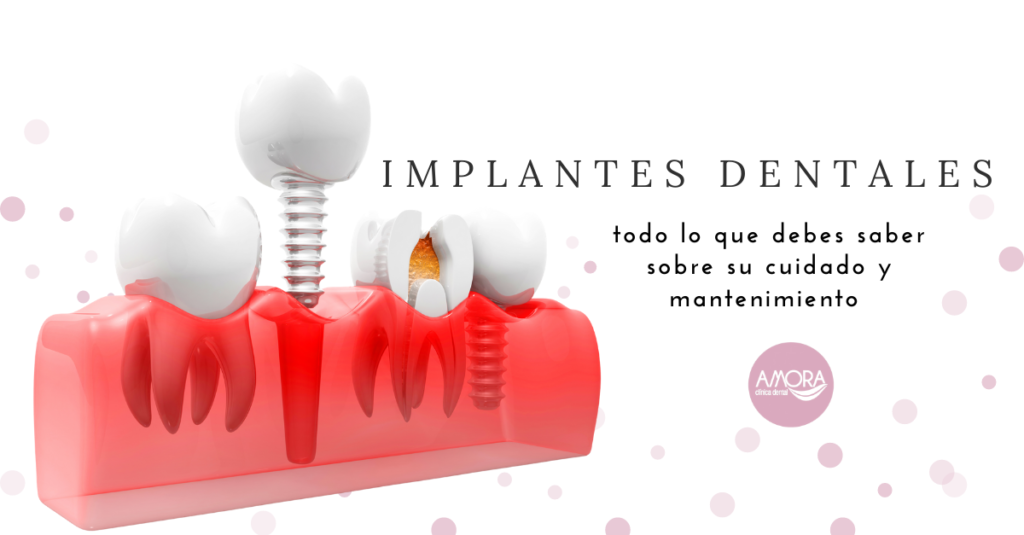 implantes dentales mantenimiento y cuidados