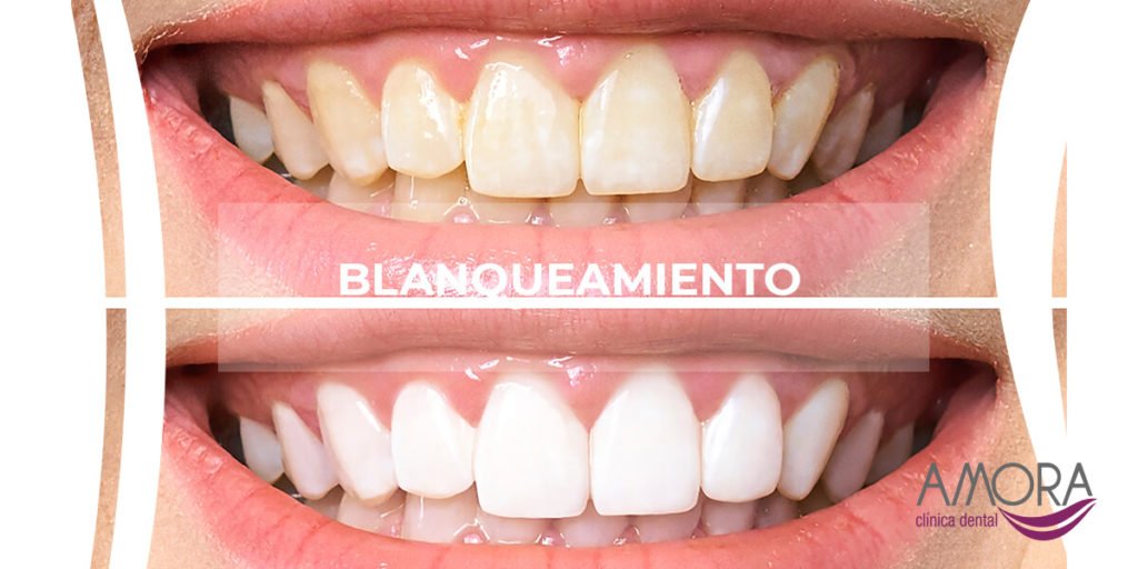 Blanqueamiento dental, clínica dental en Sabadell