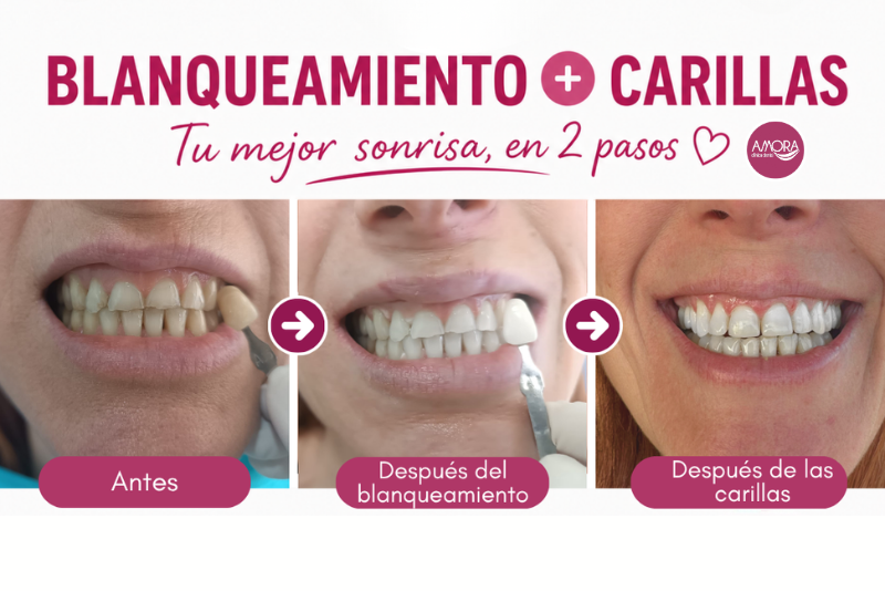 Blanqueamiento y carillas dentales en Sabadell