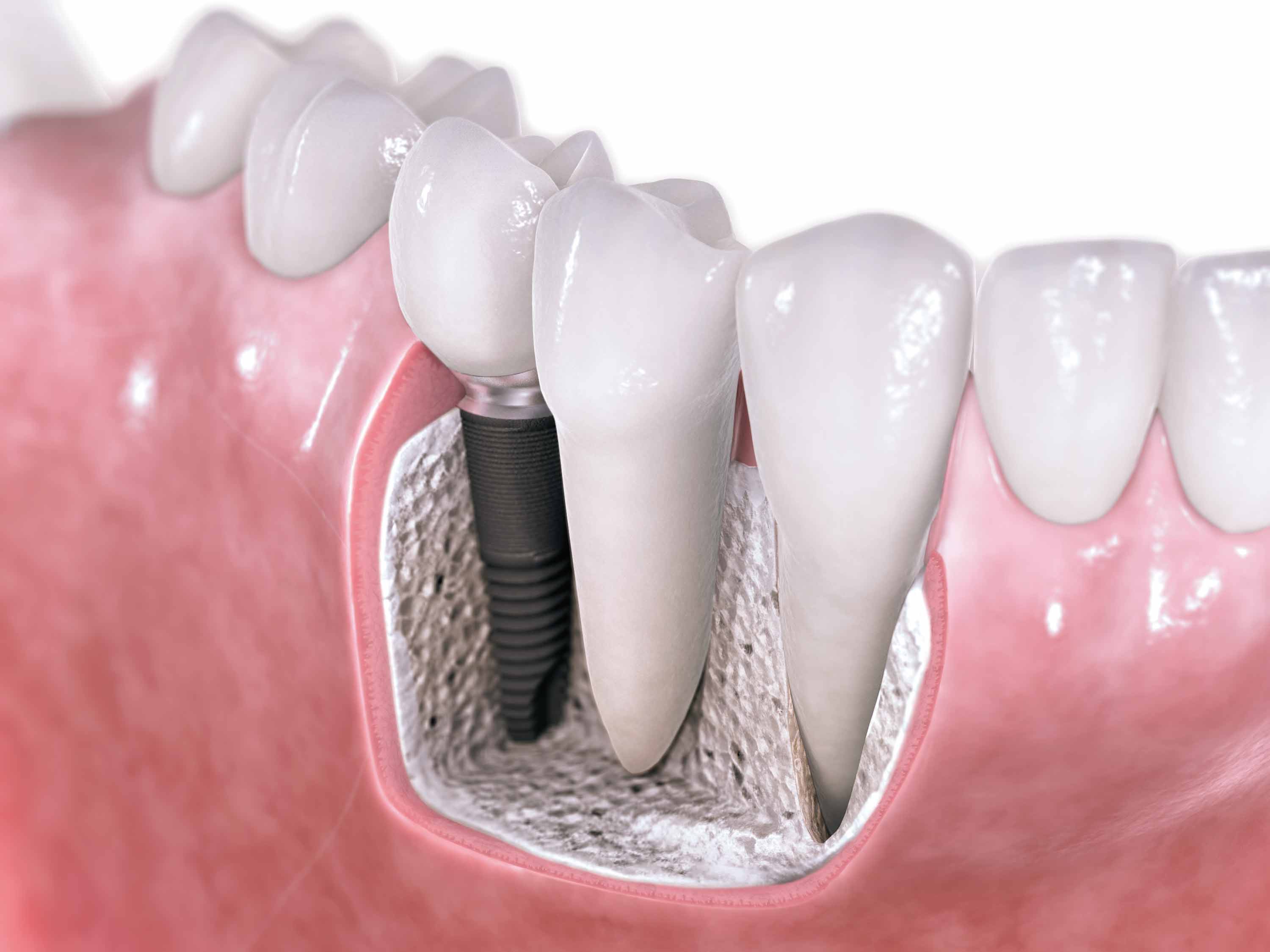 Implantes dentales Adín fiabilidad