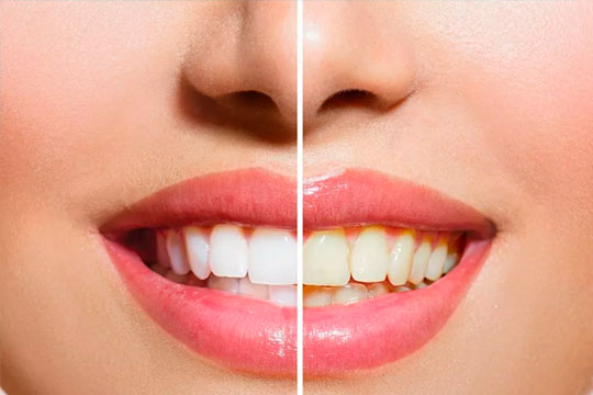 blanqueamiento_dental