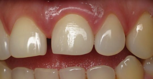 mis dientes se mueven gingivitis