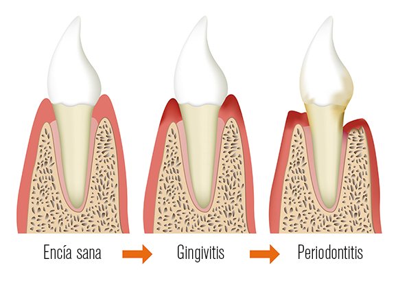 periodotitis vs Gingivitis amora dental Periodoncia