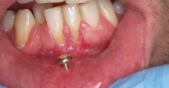 piercing bucal problemas dentales