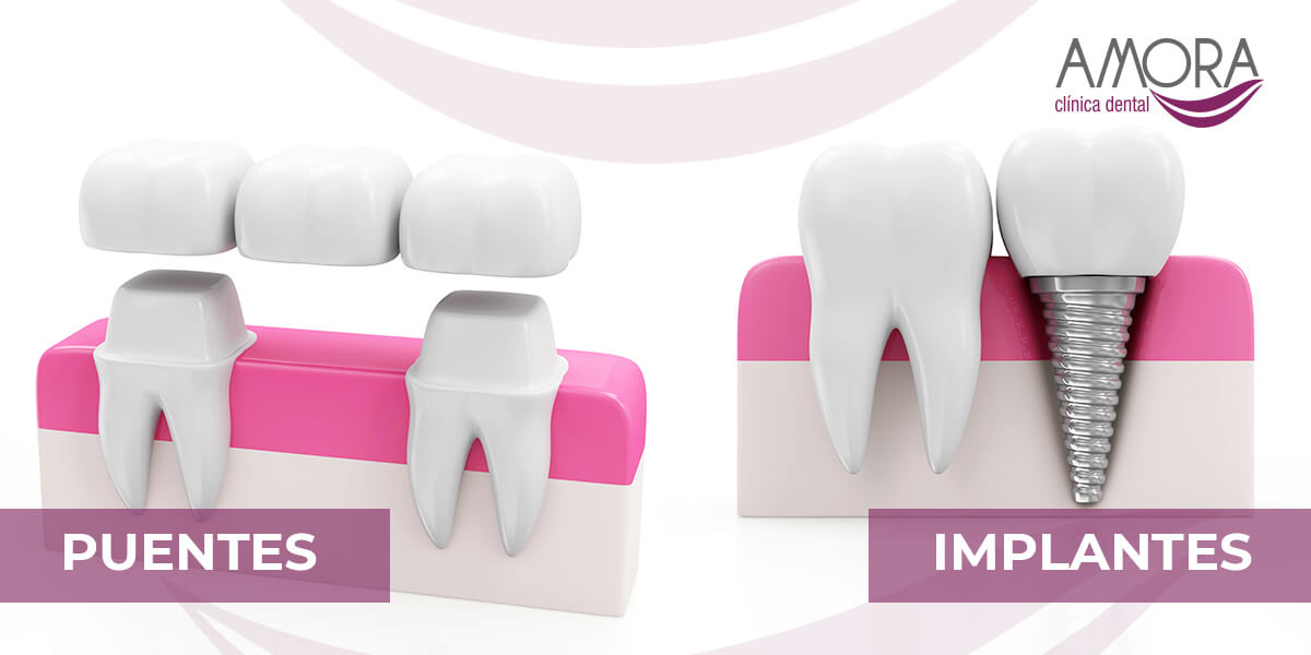 Diferencias entre los implantes y puentes dentales
